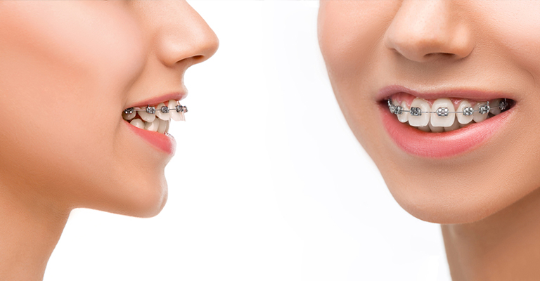 Braces/Orthodontics