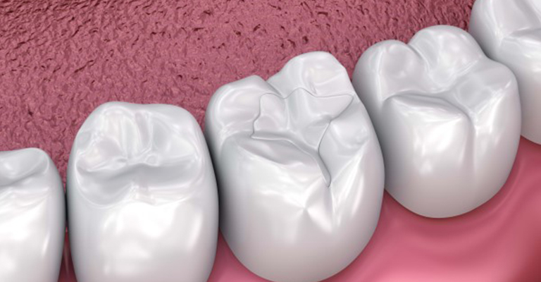 Dental fillings