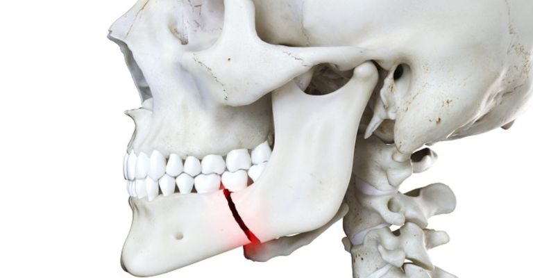 Facial trauma/ fracture